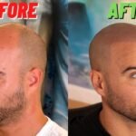 Scalp Micropigmentation Manchester